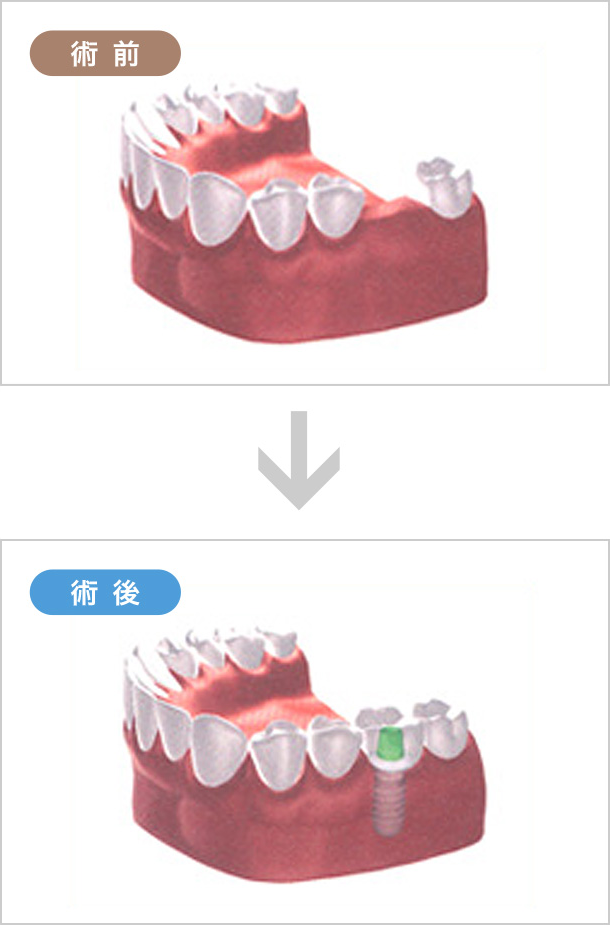歯が1本ない場合は、隣の歯を削らずに修復