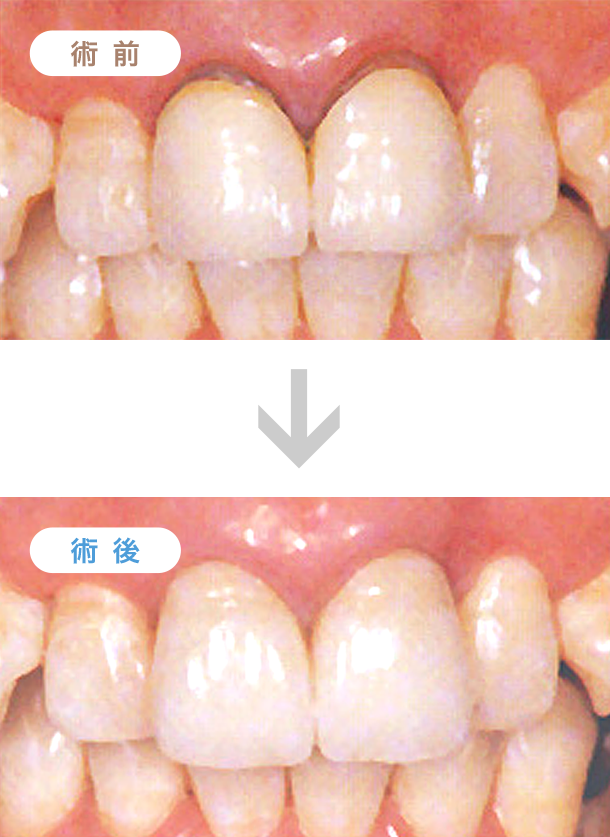 前歯部審美障害の補綴治療例