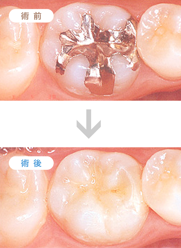 臼歯部審美障害の補綴治療例